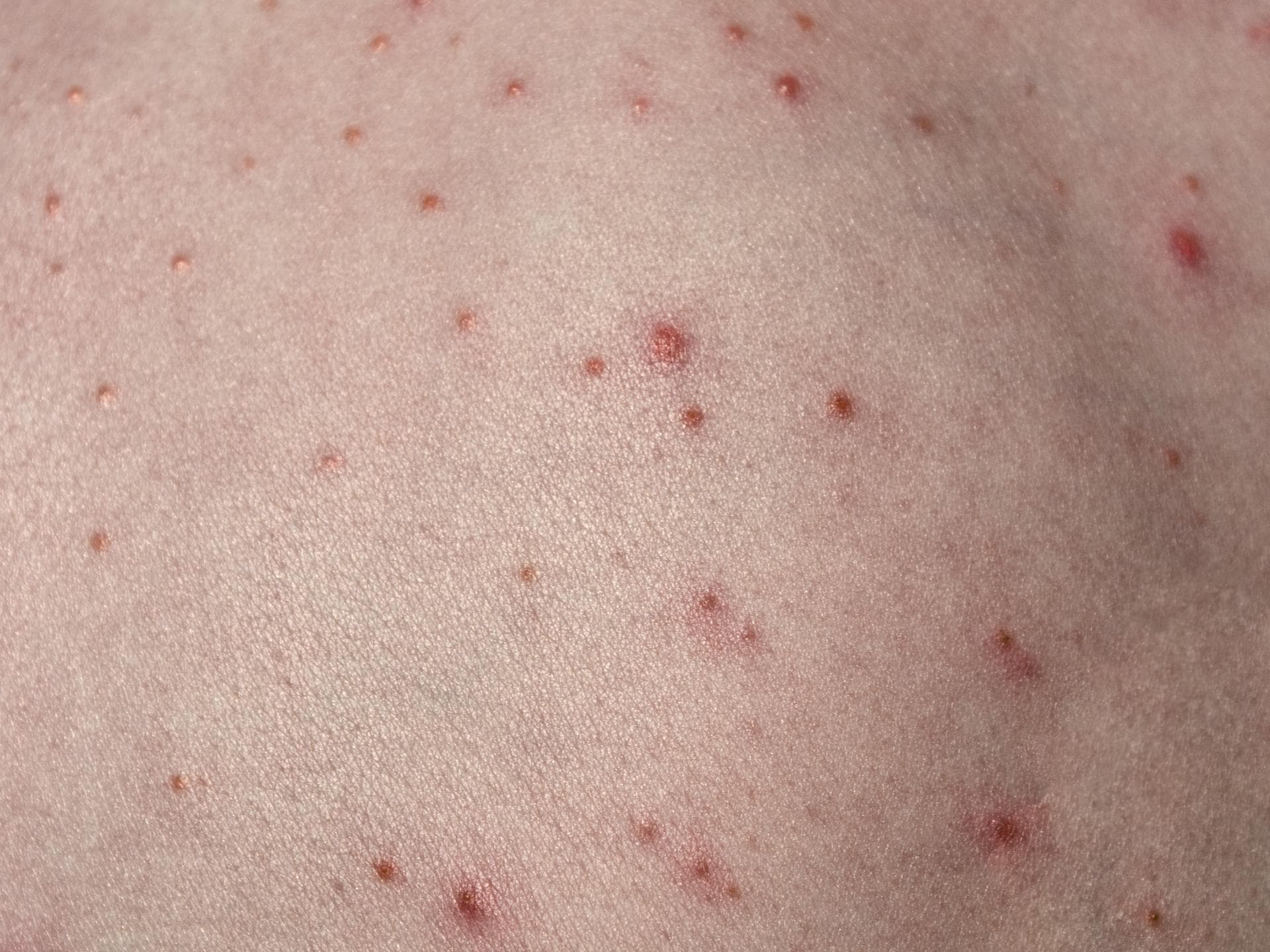 Haut mit roten Pusteln darauf Haut mit roten Pusteln darauf