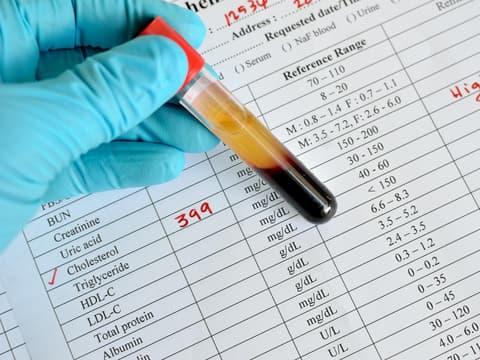 Neue Studien zeigen jedoch, dass zu viel HDL-Cholesterin auch schädlich sein kann. Neue Studien zeigen jedoch, dass zu viel HDL-Cholesterin auch schädlich sein kann.